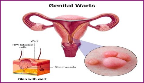 Can genital warts appear during pregnancy?
